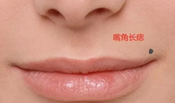 嘴角有痣女人的命運(yùn) 嘴角有痣女人的婚姻解析